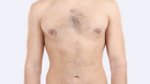 câncer de mama homem